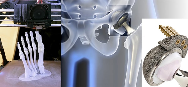 Ứng dụng in 3D trong y học để ghép xương, thay khớp nhân tạo